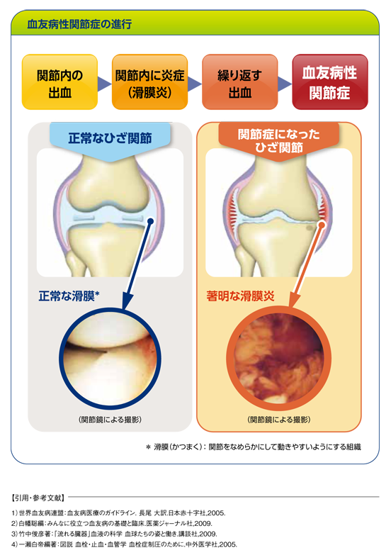 血友病性関節症の進行